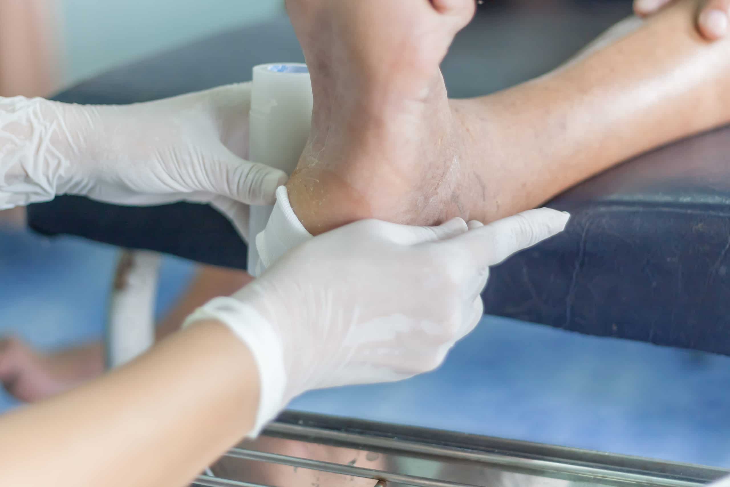 Treating infected wound of diabetic foot