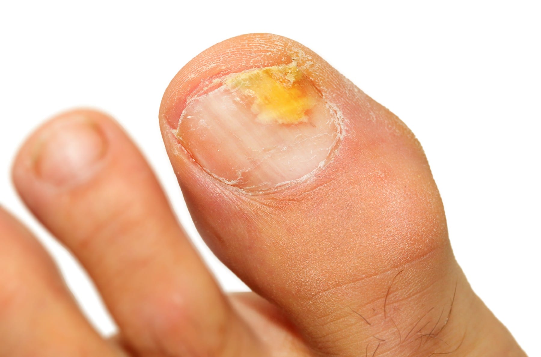 a close up of a toe with toenail fungus