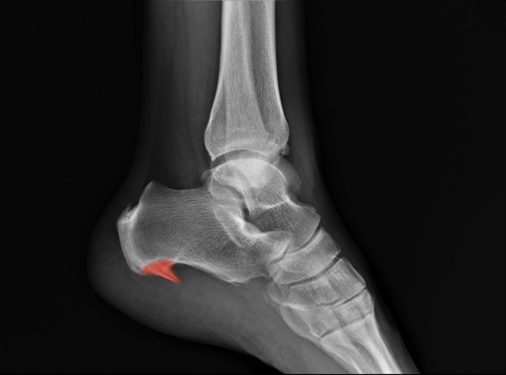 Heel spurs shown in a X-ray