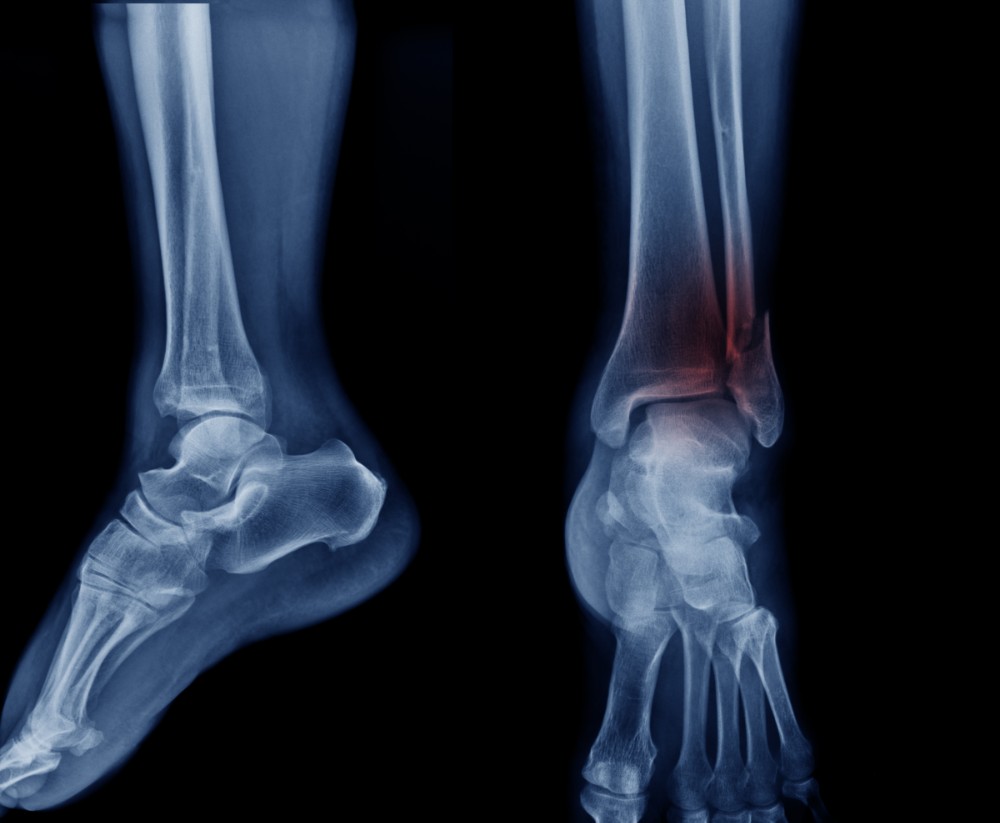 Ankle fracture shown in x-ray