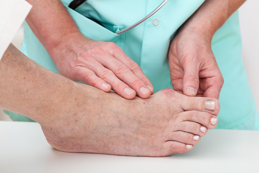Doctor examining foot with bunion