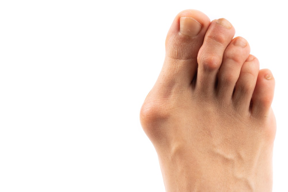 Foot with bunion